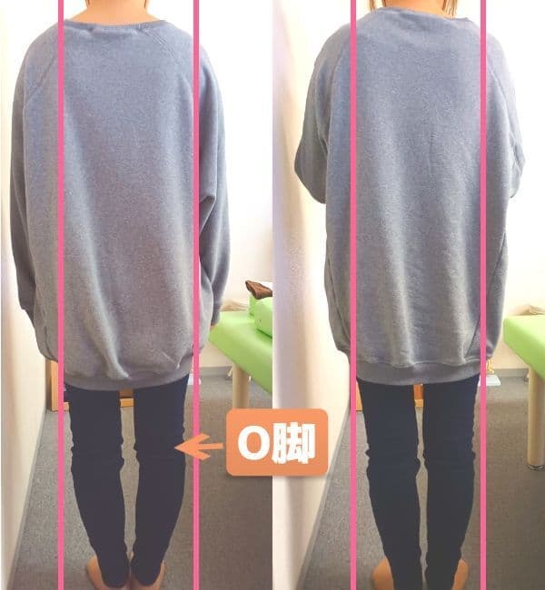 産後骨盤矯正施術後